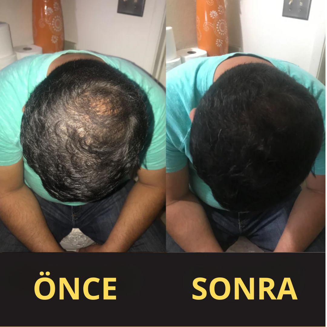 HairFillUp Siyah Saç Kapatıcı – 50 ml